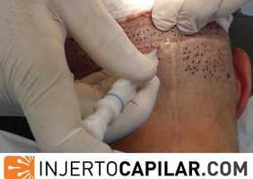 Free download 251FUE Grafts in scar. Stick and place with implanter by Dr. Lorenzo . Injertocapilar.com.2270/2018. video and edit with RedcoolMedia movie maker MovieStudio video editor online and AudioStudio audio editor onlin