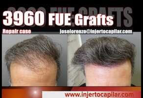 Free download 3960FUE Grafts.NW IIIV.Repair case with plugs extraction.Final outcome. Injertocapilar.com.2591/2020 video and edit with RedcoolMedia movie maker MovieStudio video editor online and AudioStudio audio editor onlin