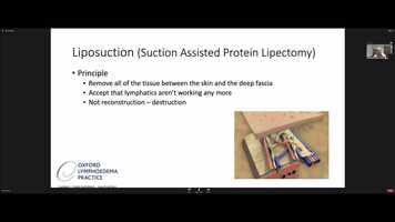 Free download Professor Furniss talks through liposuction for lymphoedema video and edit with RedcoolMedia movie maker MovieStudio video editor online and AudioStudio audio editor onlin